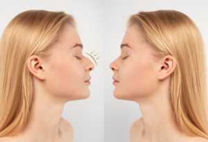 burun estetiği istanbul