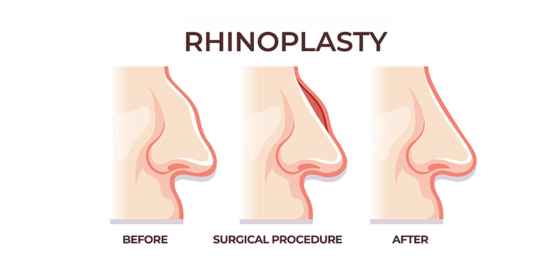 Rhinoplasty in Turkey, Istanbul with London Consultation