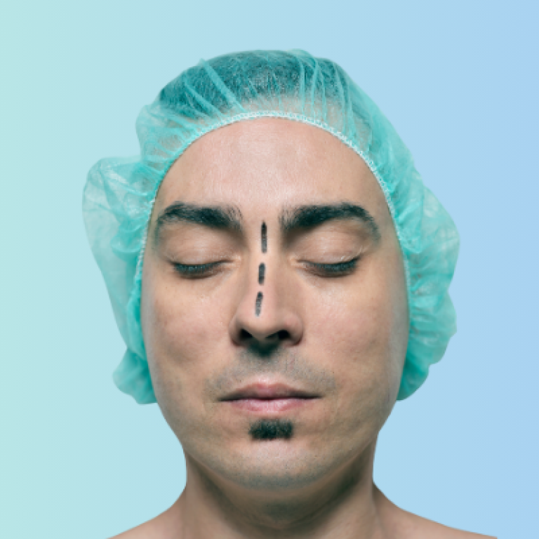 erkeklerde-burun-estetigi